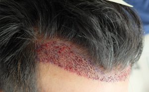 Geheimratsecken beseitigen durch eine Haartransplantation - Kosten